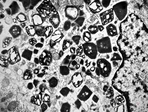 M,58y. | crystalline inclusions in hepatocyte after unknown medication M,58y. | crystalline inclusions in hepatocyte after unknown medication